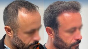 ICEFUE Hair Transplant at Kangnam – Preserving Hair Follicles, Restoring Natural-Looking Hair