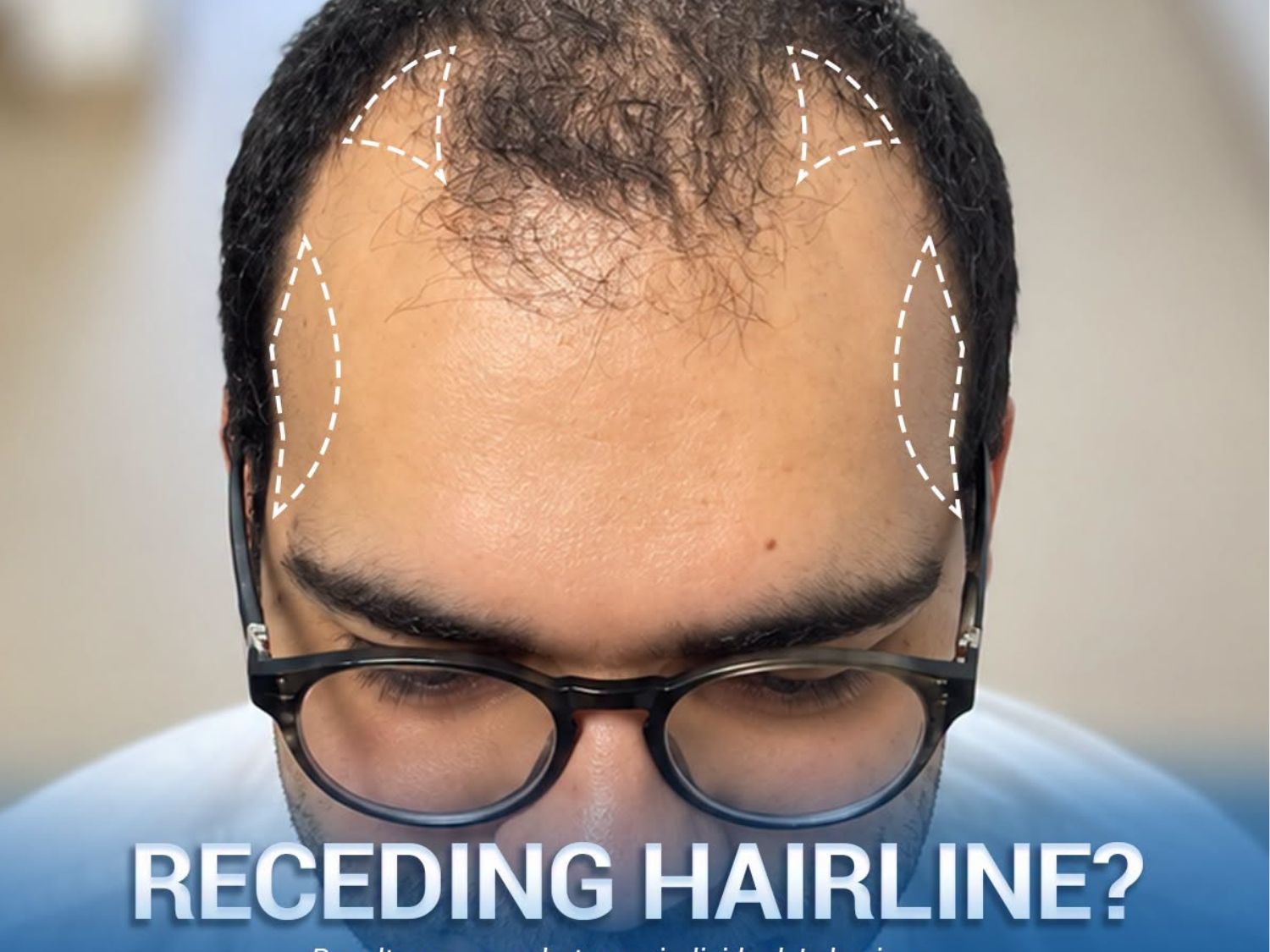 A receding hairline is often most noticeable across the frontal hairline and temples, making the forehead appear higher and the hair at the front look thinner.