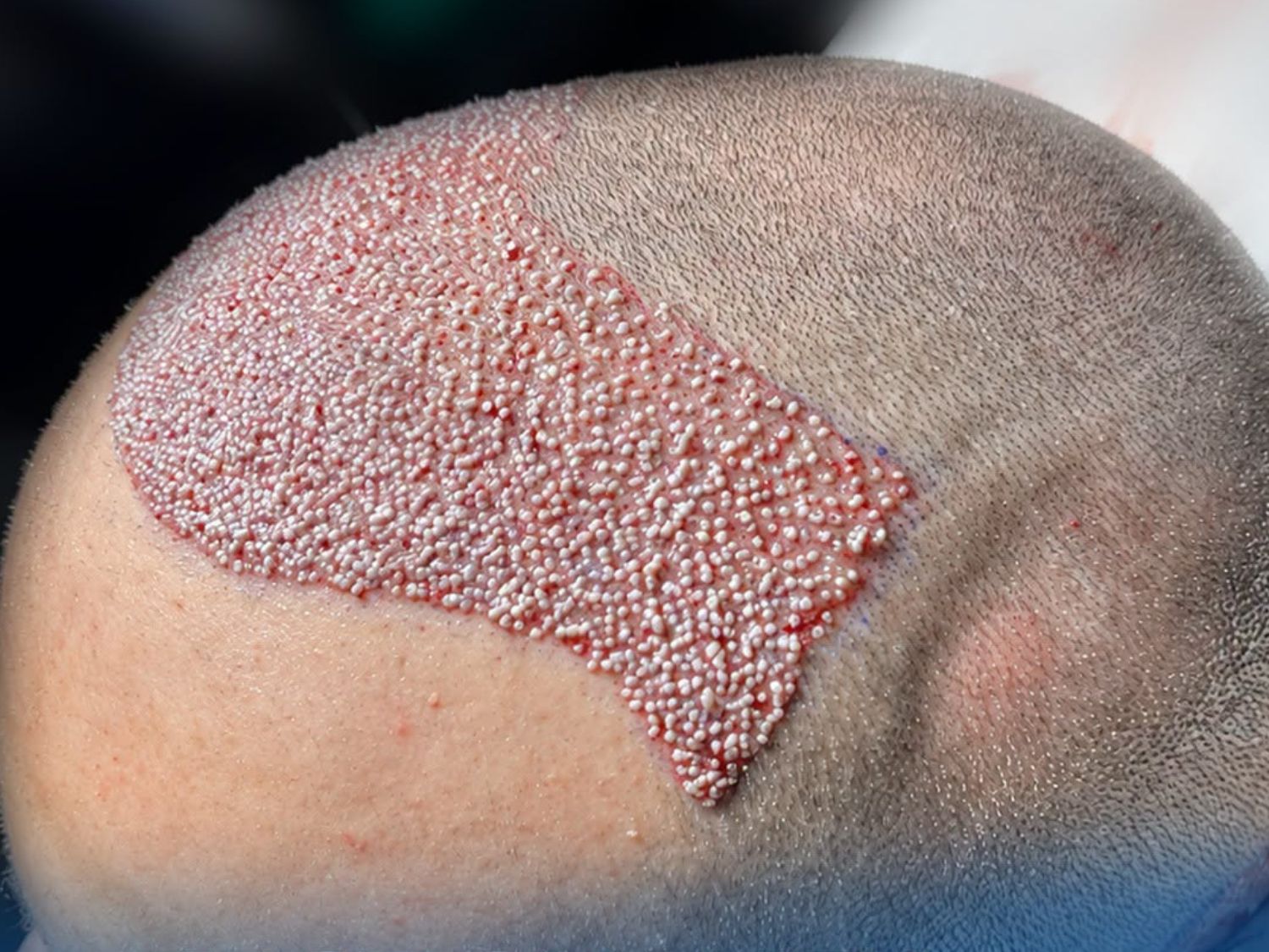 The recipient area immediately after transplantation, with follicles positioned according to the predetermined density and growth direction to reconstruct the hairline and improve thinning areas.