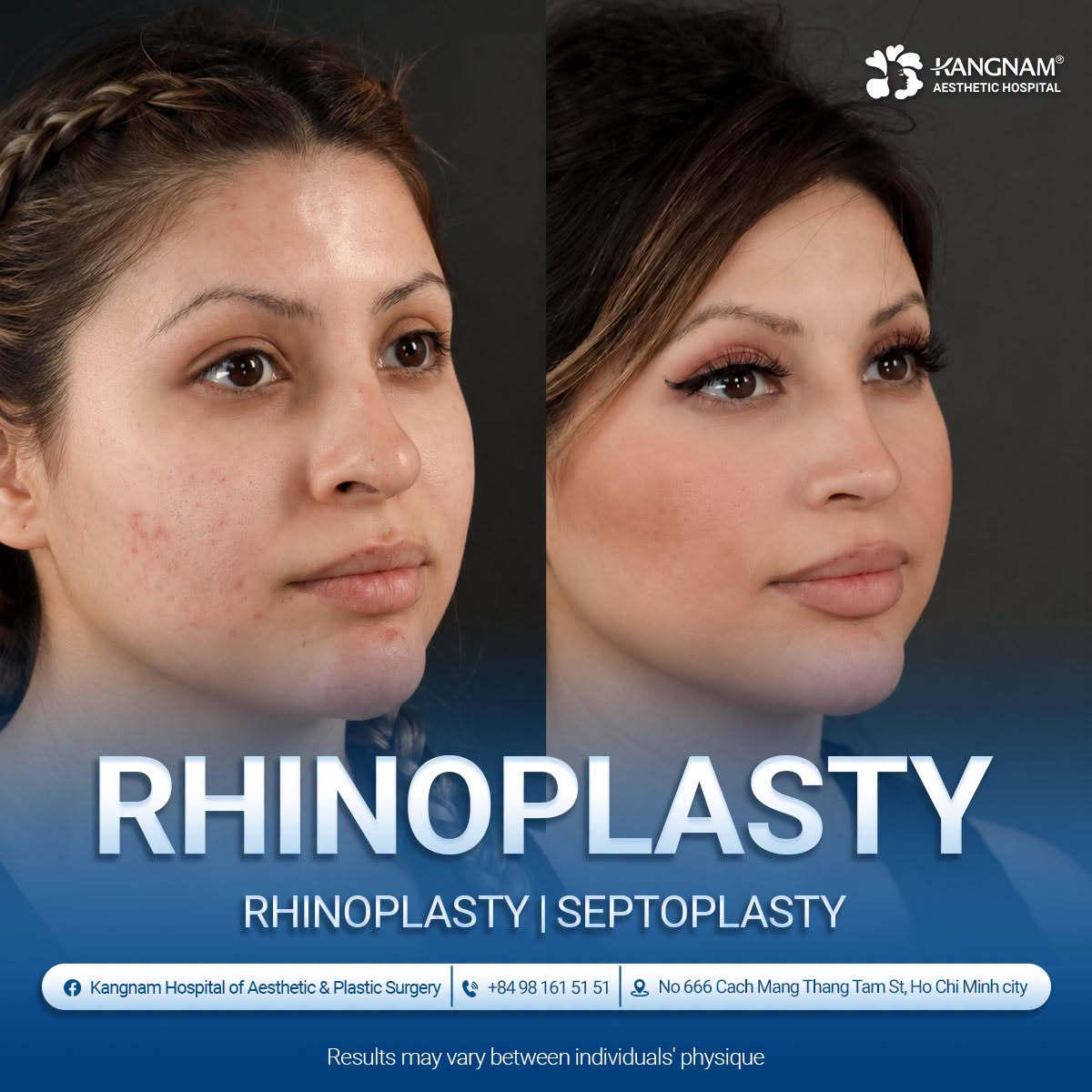 Before and after rhinoplasty at Kangnam, showing changes in nasal shape and overall facial proportions. Individual results may vary.