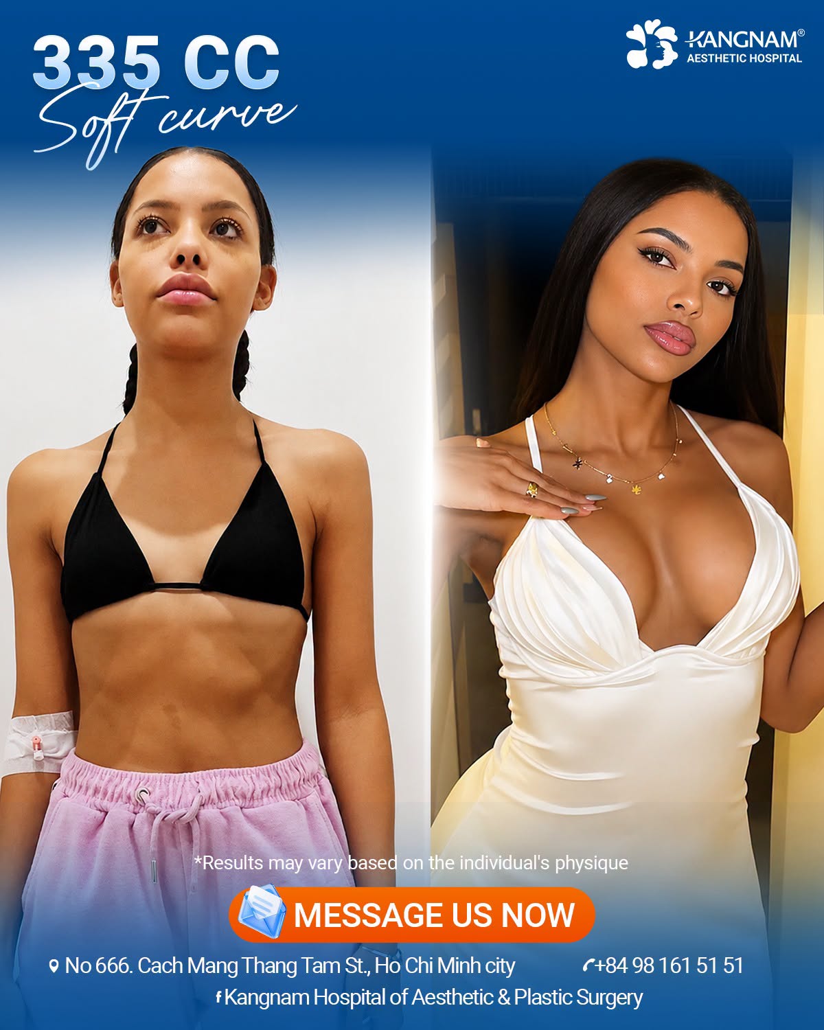 Before and after 335cc breast augmentation at Kangnam, demonstrating changes in breast volume and contour. Individual results may vary.