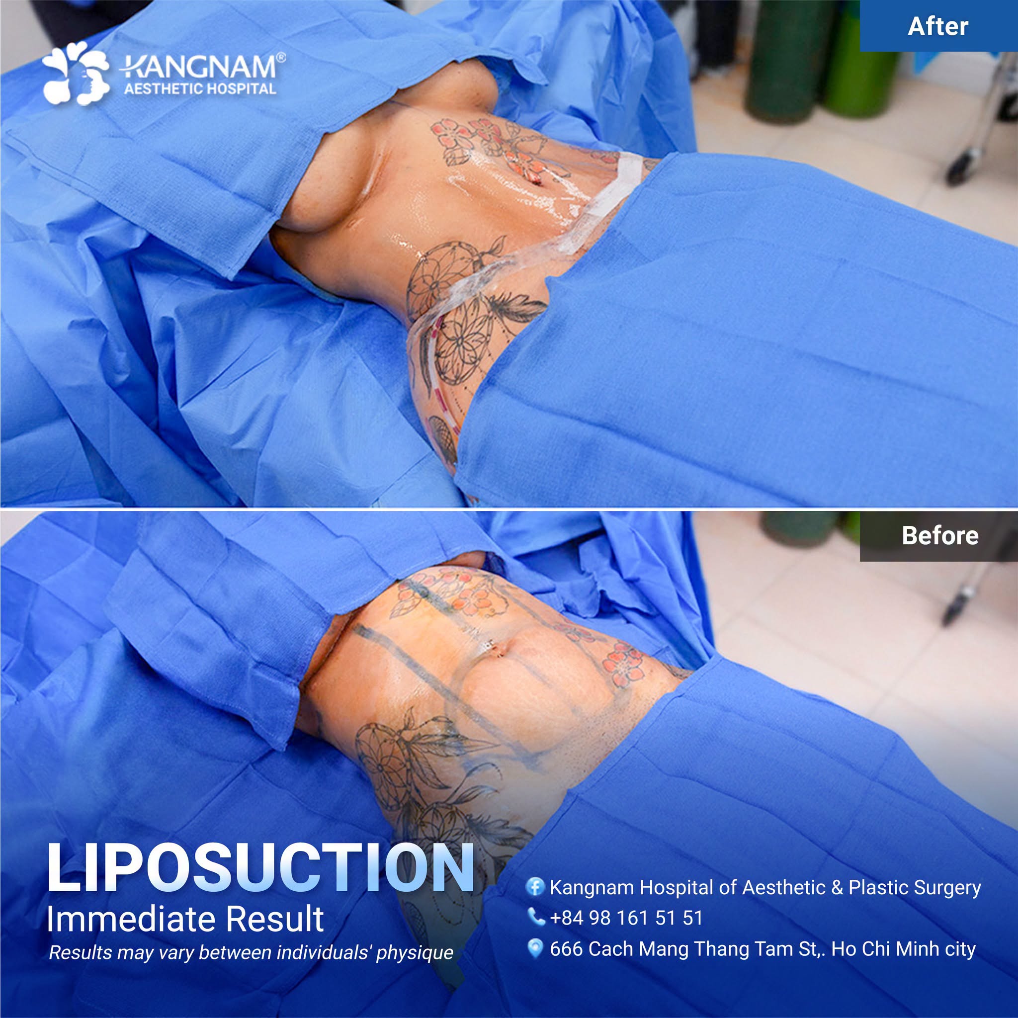 Before and immediate postoperative view of liposuction at Kangnam, illustrating changes in body contour after the procedure.