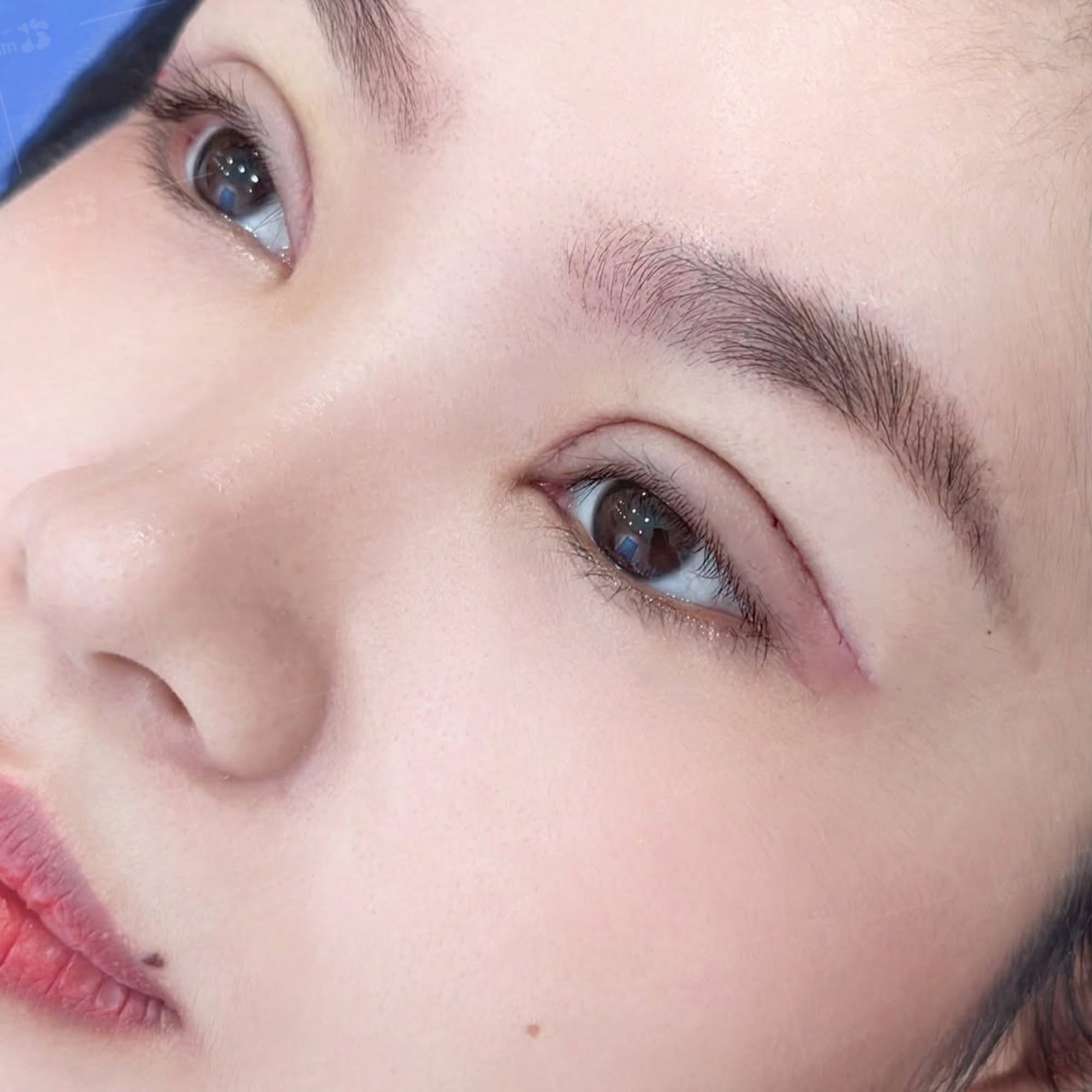 After blepharoplasty, mild eyelid swelling, bruising, and redness along the incision lines may occur during the early healing period. However, rapidly increasing swelling, worsening pain, spreading redness, unusual discharge, or changes in vision require prompt medical evaluation to rule out potential complications.