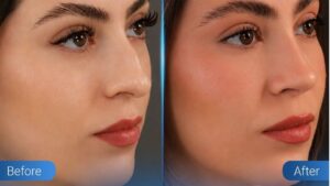 Korean-style structural rhinoplasty in Vietnam — what does it mean?