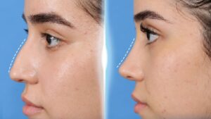 Cosmetic Surgery Warranty in Vietnam: Terms and Benefits for International Patients and Overseas Vietnamese