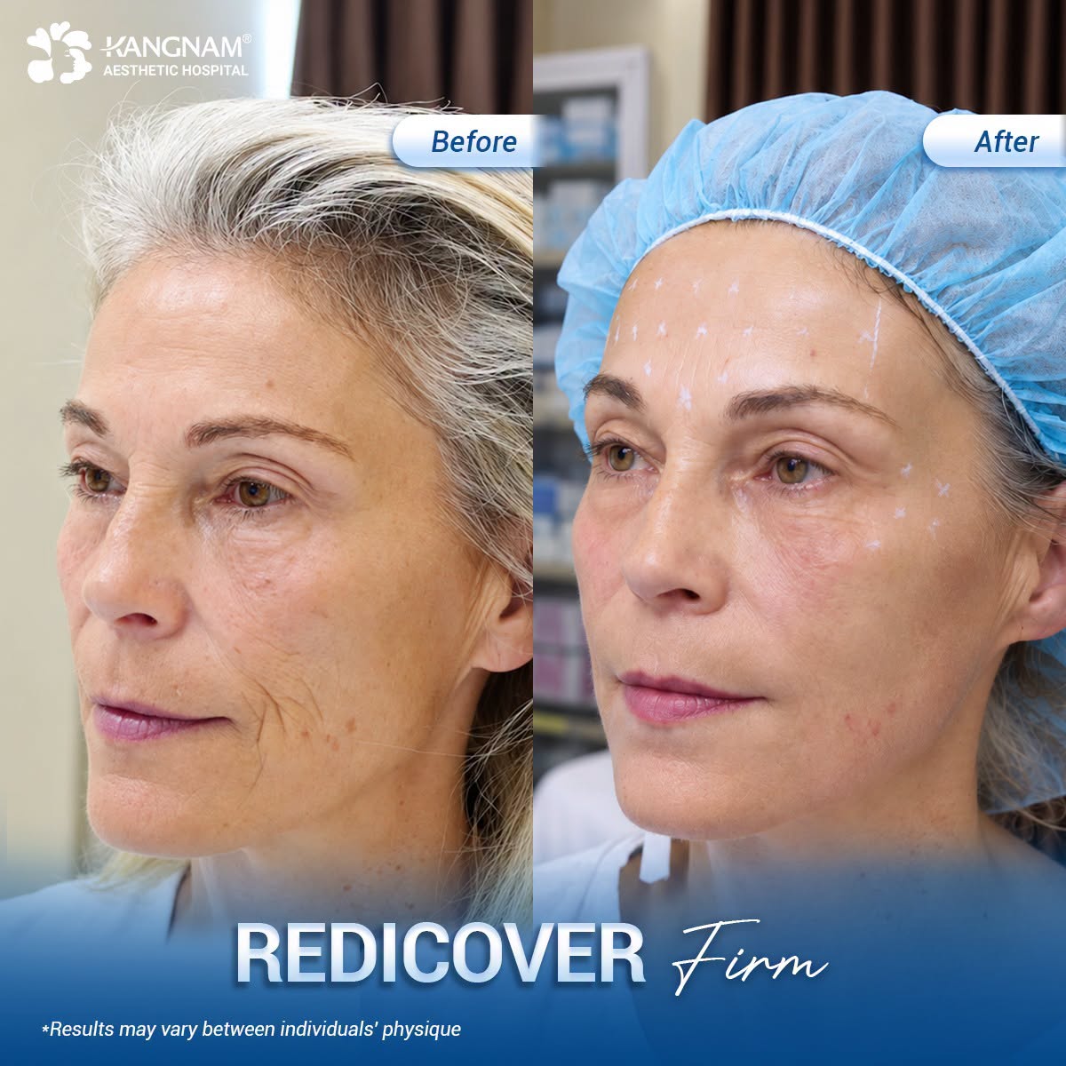 Vietnam is particularly well known for Botox, dermal fillers, laser treatments, skin tightening, and pigmentation treatments are also widely available