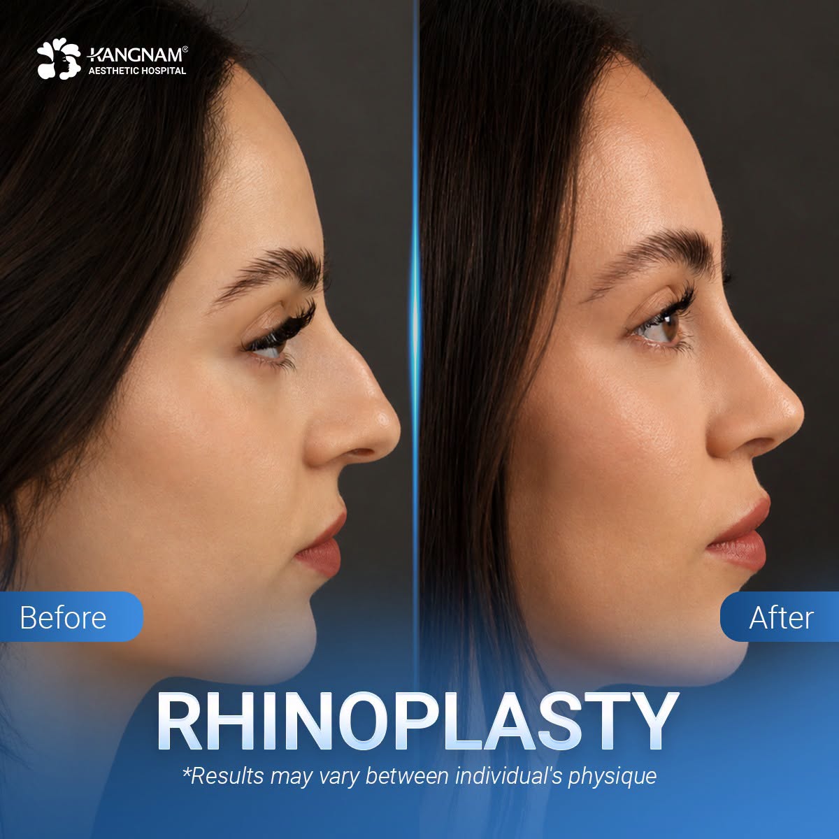 Rhinoplasty is one of the most popular cosmetic surgical procedures in Vietnam