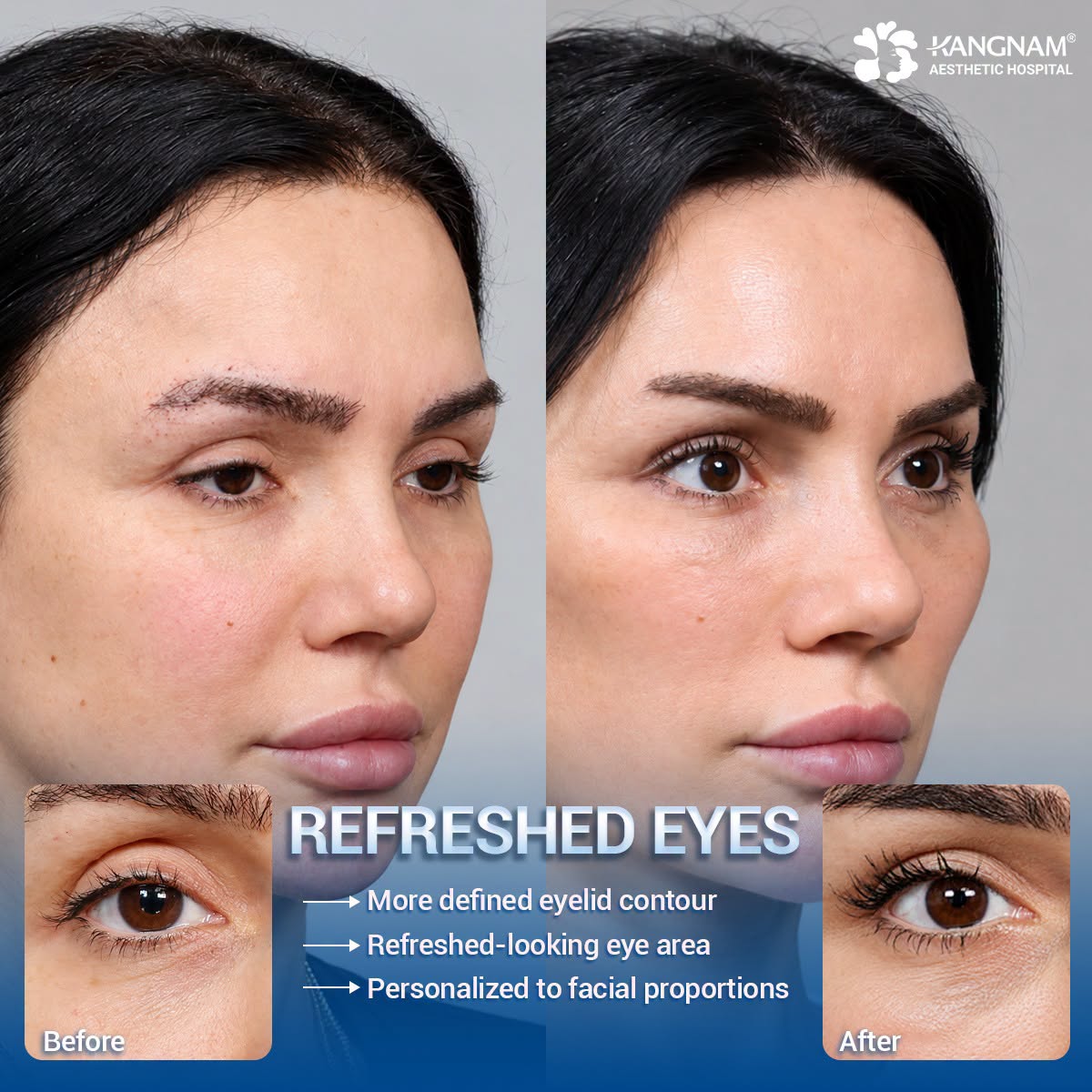 Before-and-after images show changes in the eye area after surgery, with a more defined eyelid contour and a refreshed appearance. Individual results may vary.