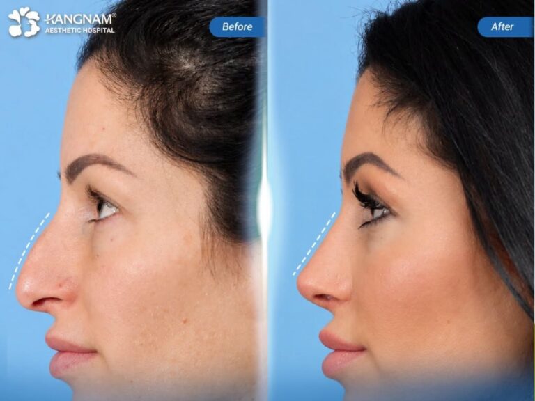 Rhinoplasty in Ho Chi Minh City — cost and best surgeons?