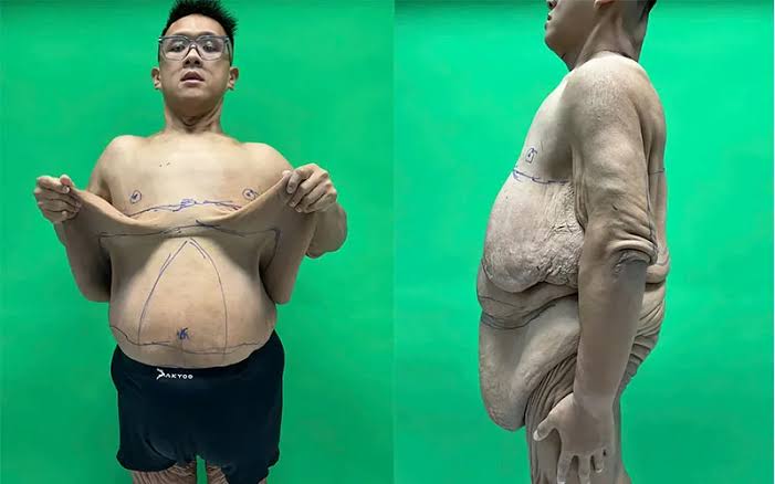 Tan Nhan had experienced an extraordinary weight-loss journey, reducing his body weight from 264 kg to 95 kg—a loss of more than 160 kg